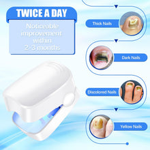 Rechargeable Nail Fungus Treatment for Toenail, Toe Nail Fungal Treatment Nail Fungus Laser Device, Anti-Fungal Nail Treatment for Hand & Feet Infections Remover for Home Use